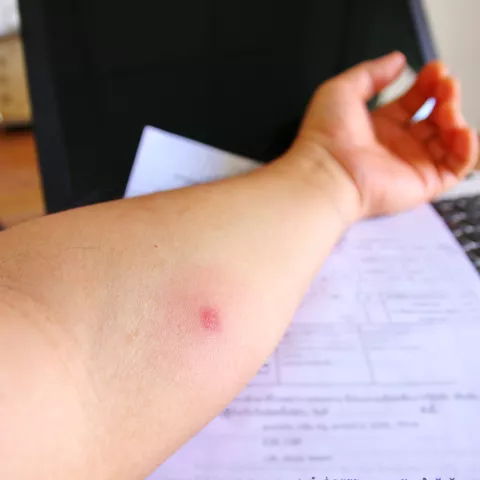 TB skin test spot on arm