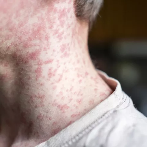 Measles viral on a man's neck