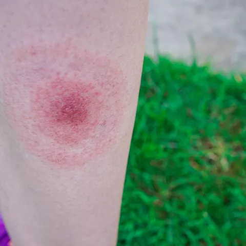 Lyme disease, Borreliosis or Borrelia, typical lyme rash, spot