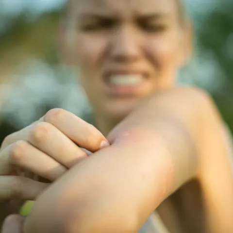 A woman scratching her itchy mosquito bite.