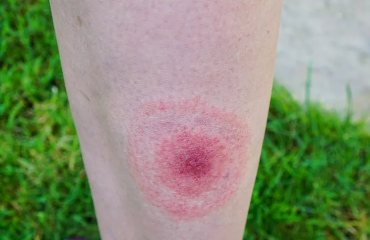 bullseye rash