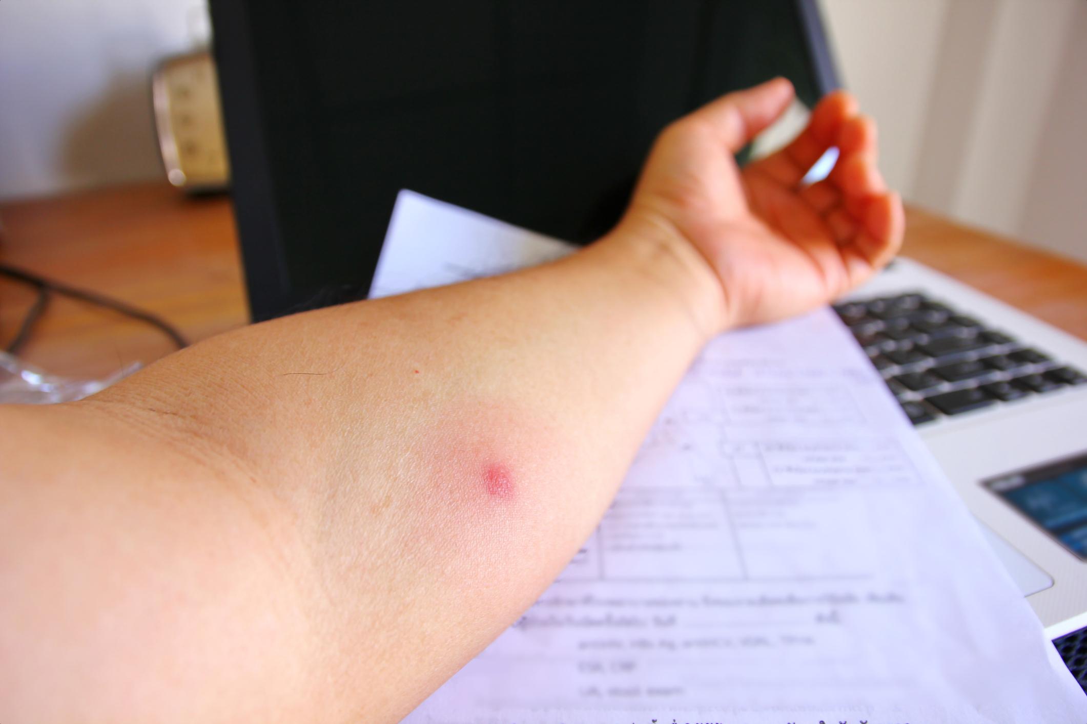 TB skin test spot on arm