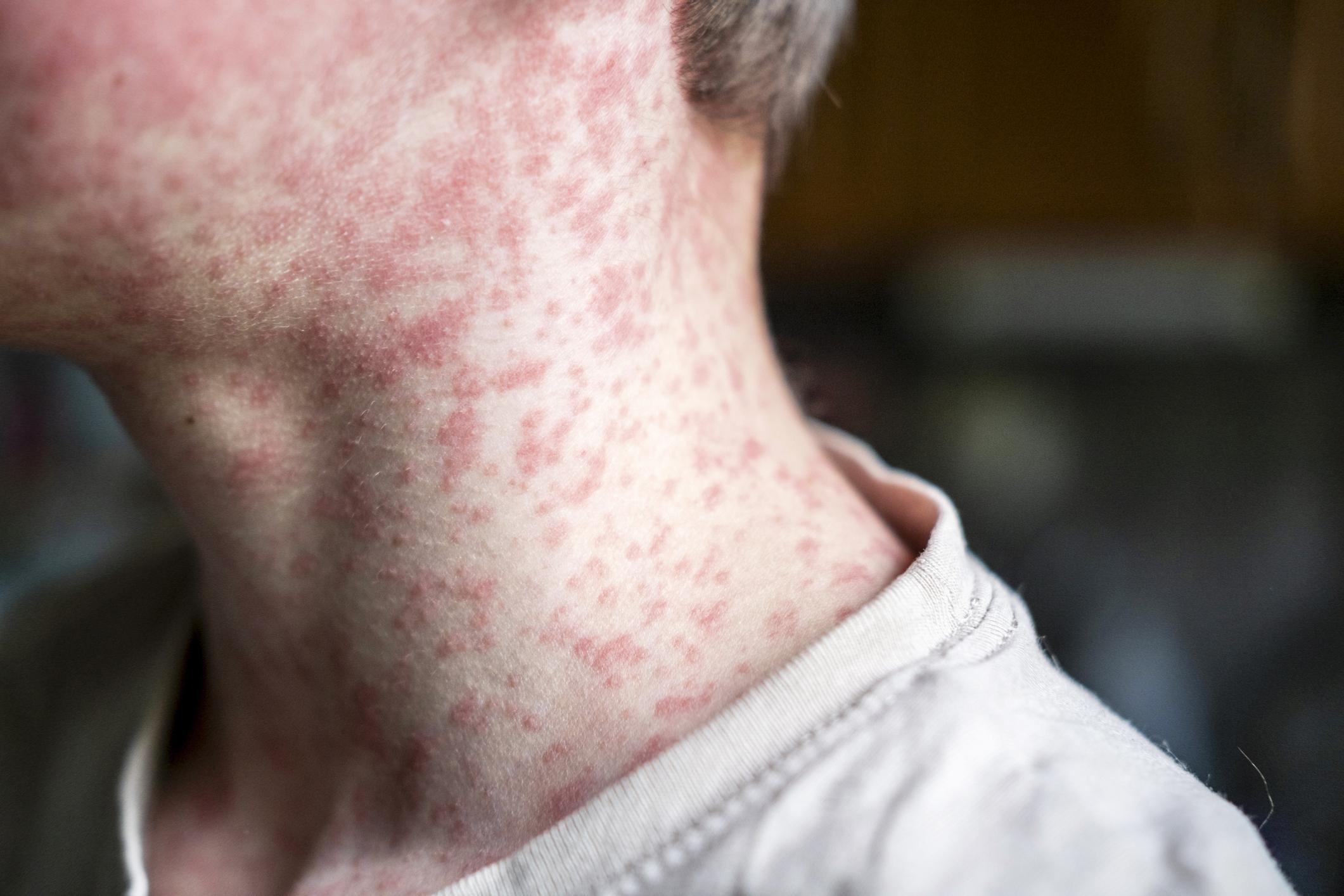 Measles viral on a man's neck