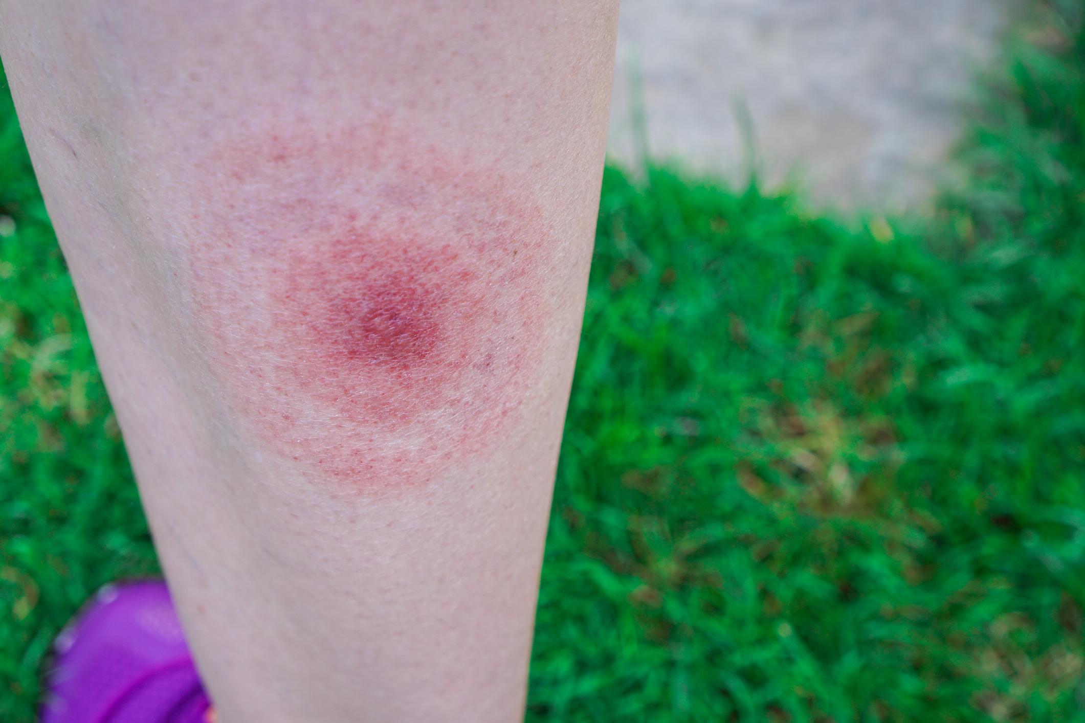 Lyme disease, Borreliosis or Borrelia, typical lyme rash, spot